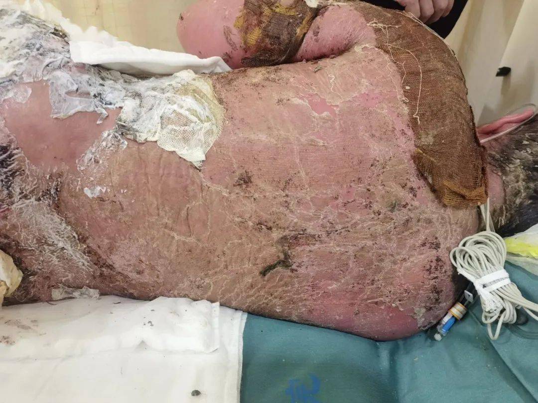 老人治肾结石后全身皮肤像衣服般脱落，一场医学奇迹的背后